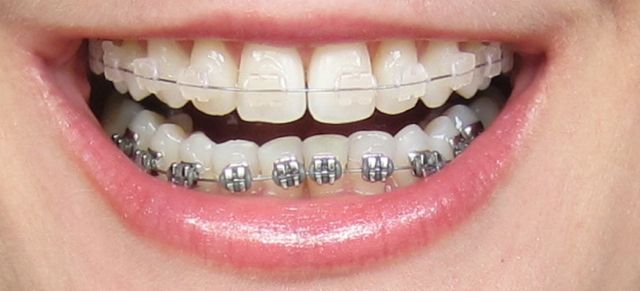 invisibleBraces