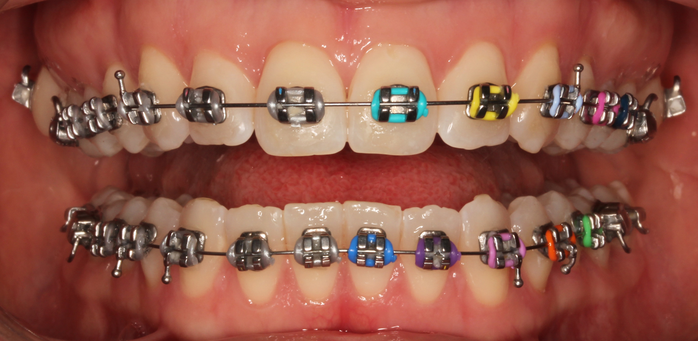 metalBraces